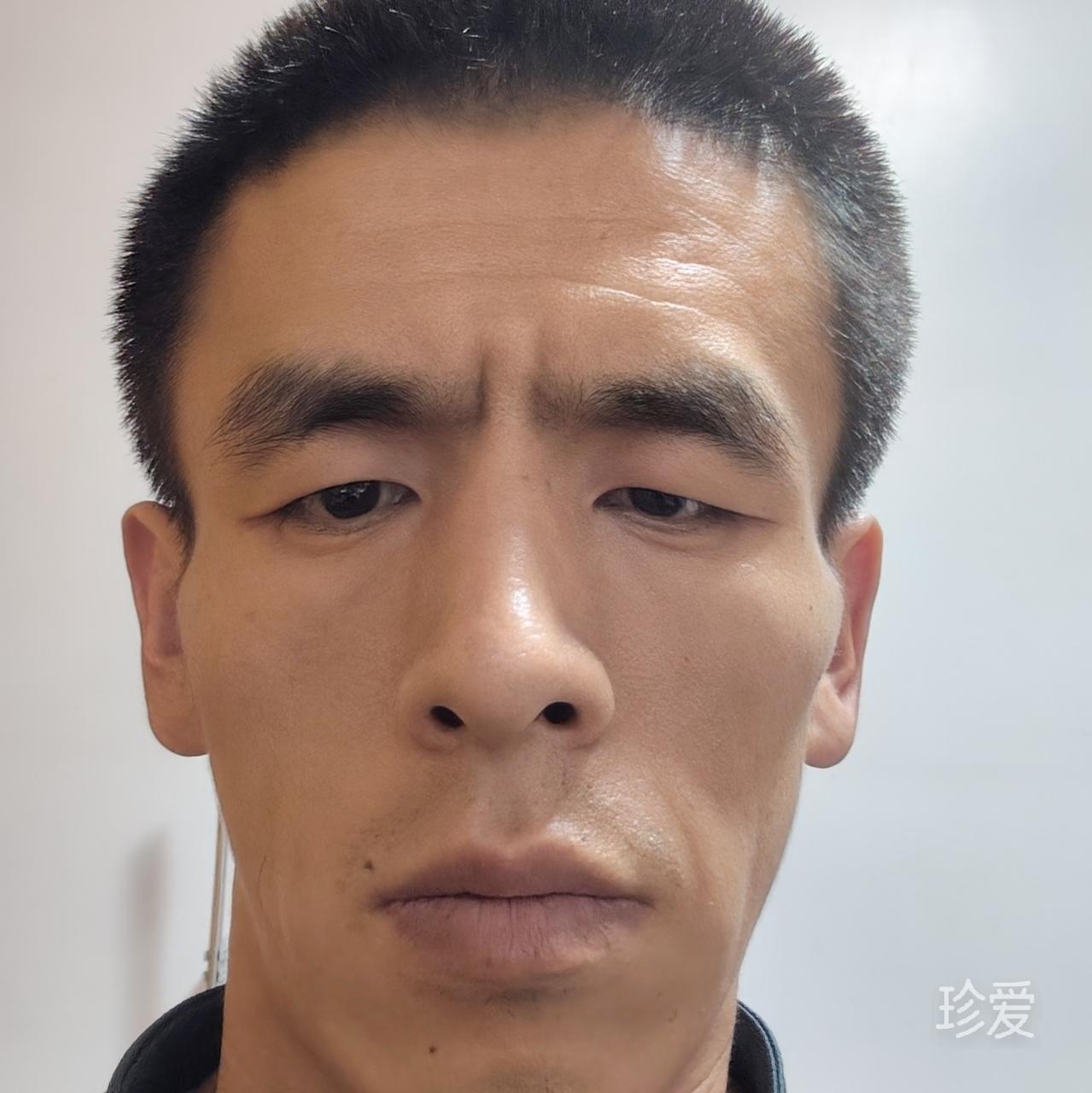 我是聋人听障了